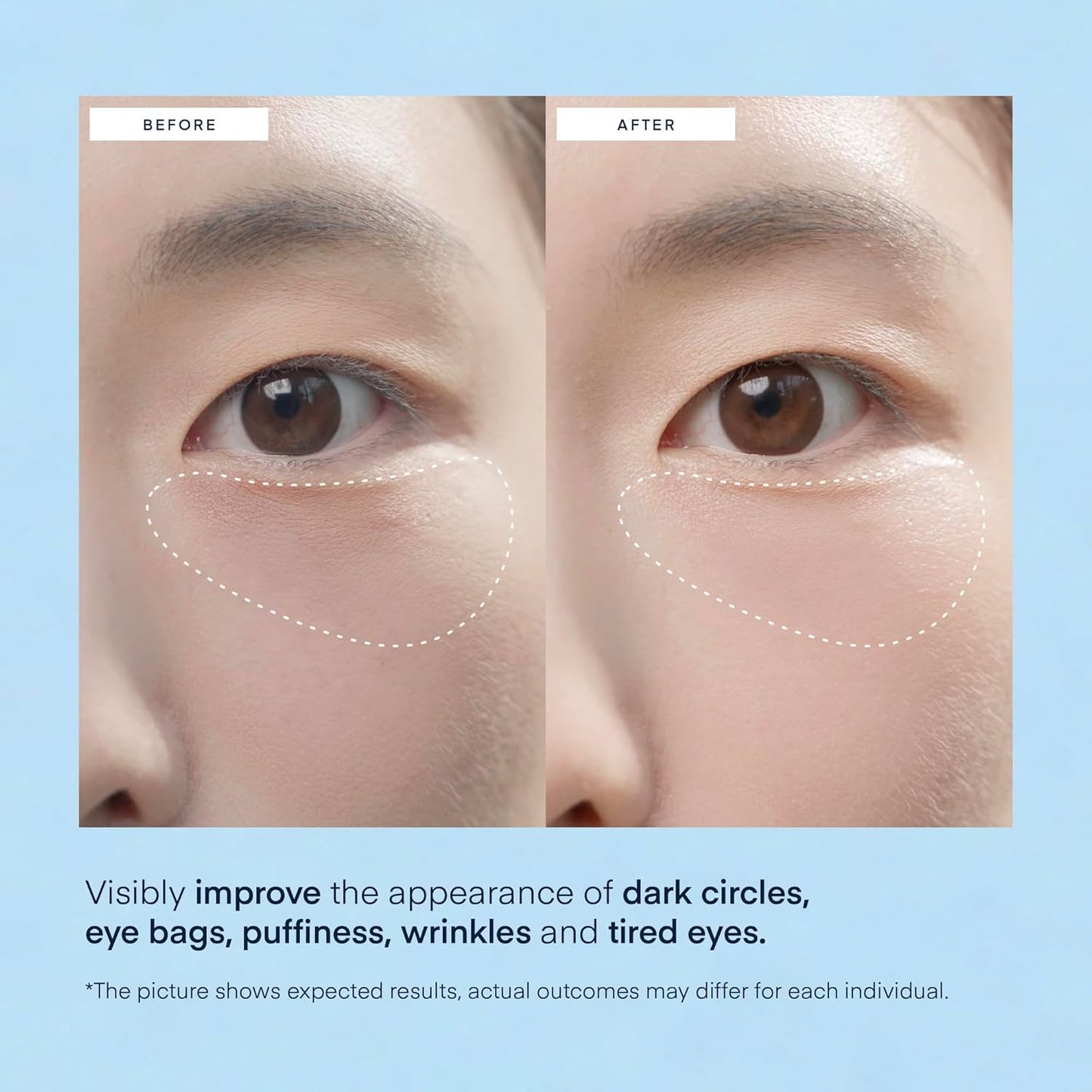 Korean Hydrating Eye Patches for Dark Circles, Puffiness & Wrinkles –  with Caffeine, Hyaluronic Acid & Niacinamide