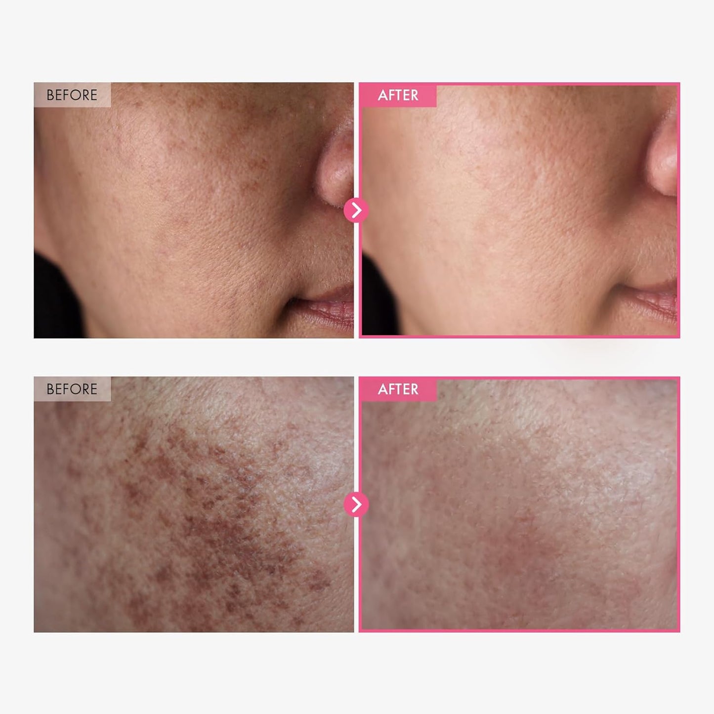 Advanced Brightening Cream with Arbutin & Tranexamic Acid – Targets Melasma, Freckles & Dark Spots